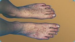 Guttate psoriasis on feet