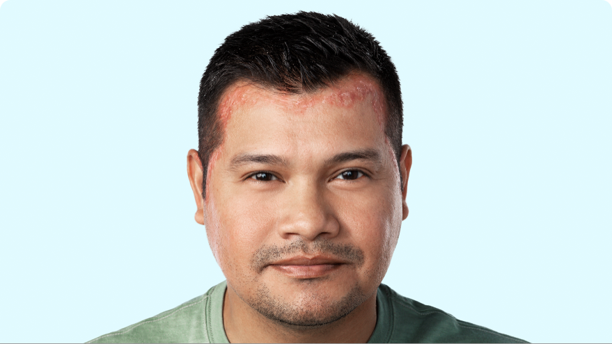 Person with scalp psoriasis