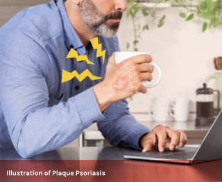 Psoriasis patient holding coffee with plaque on their hand