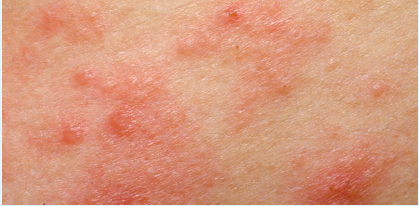 Picture of eczema