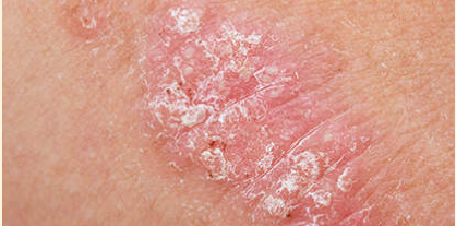 Picture of a psoriasis plaque