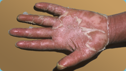 Erythrodermic psoriasis on hand