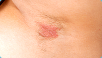 Inverse psoriasis on armpit