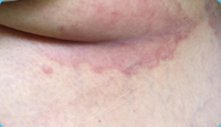 Inverse psoriasis on skin