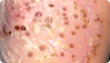 Pustular psoriasis on skin