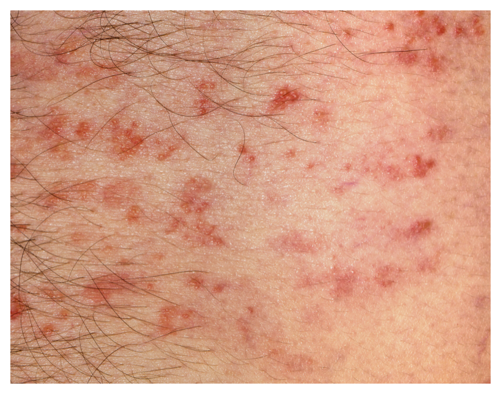 Psoriasis looks like small, red, spots on children and young adults