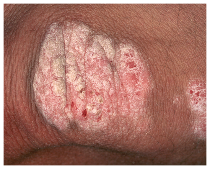 Psoriasis looks like dry skin that may crack and bleed