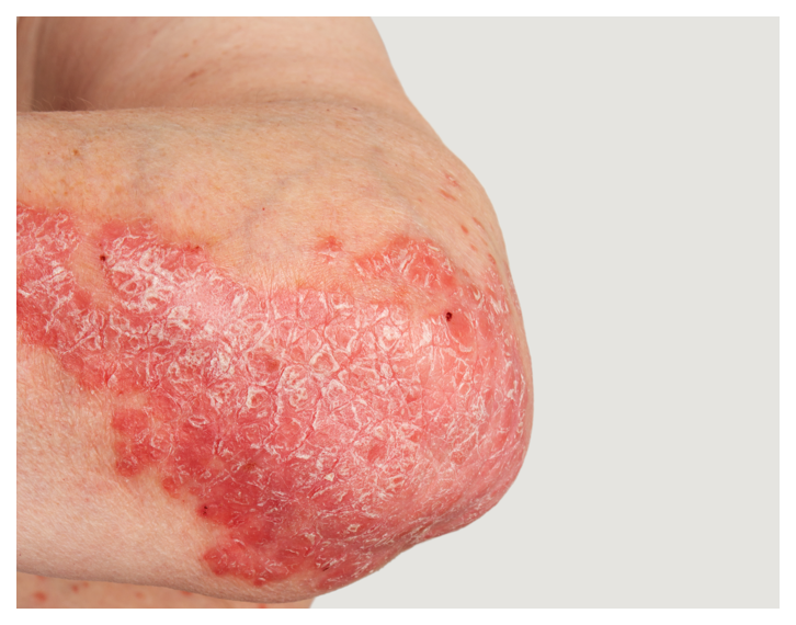 Psoriasis looks like itching, burning, or painful skin