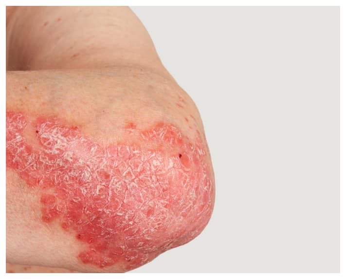 Psoriasis on an Arm and elbow