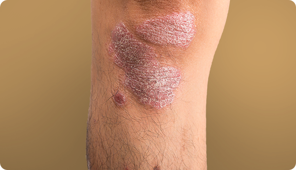Plaque psoriasis on knee