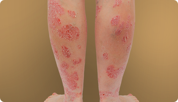Plaque psoriasis on legs