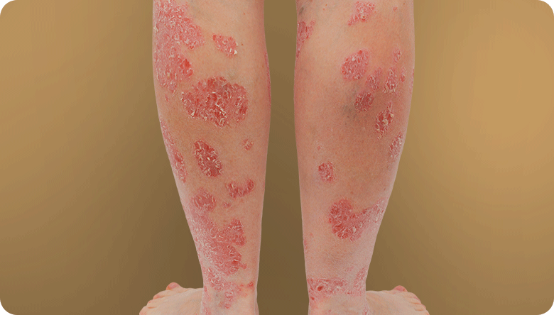 Picture of Plaque Psoriasis on Back of Legs