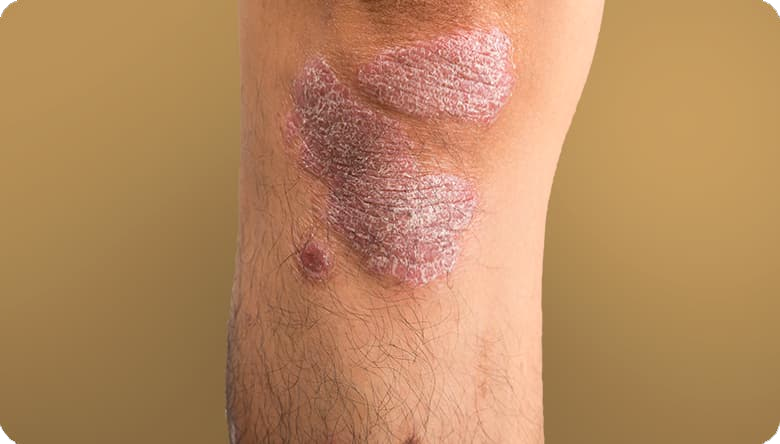 Picture of Plaque Psoriasis on Knee