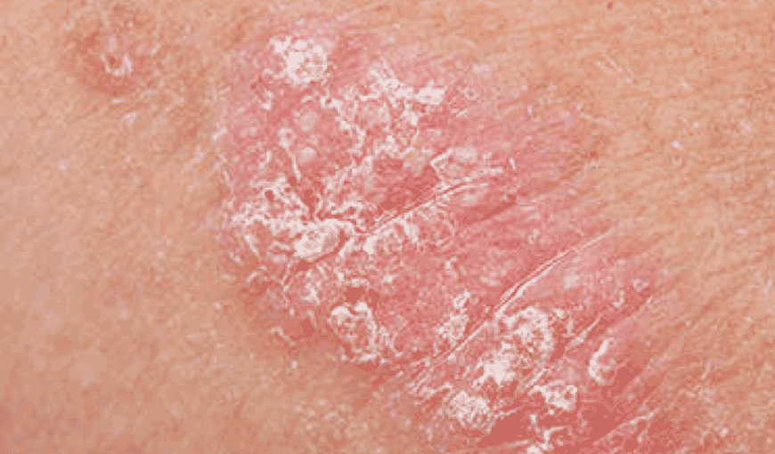 How to Tell Psoriasis Apart From Other Skin Conditions