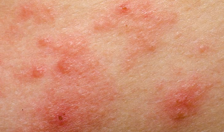 Close-up of eczema