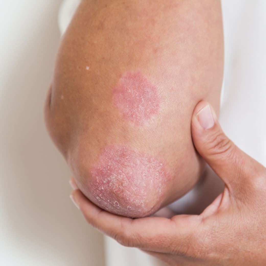 Psoriasis plaque on elbow