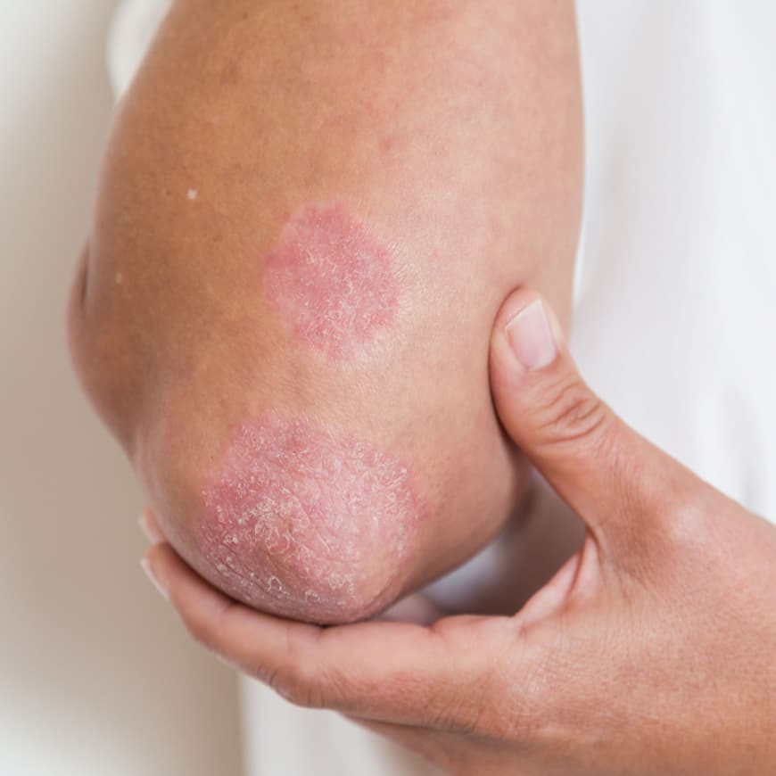 Psoriasis plaque on elbow