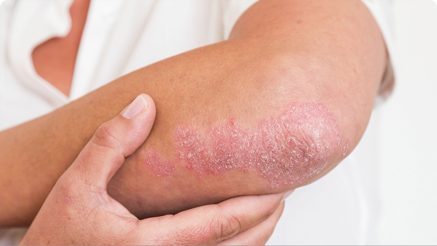 Picture of psoriasis on an elbow